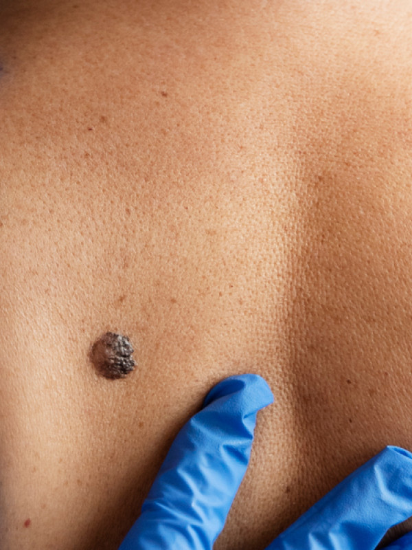  Early detection of melanoma and other skin issues